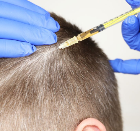 Lesser-Known Treatments for Hair Loss at Our San Francisco Dermatology Practice