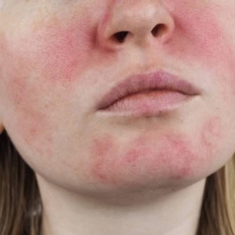 Rosacea and Diet: Foods to Avoid to Manage Symptoms