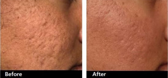 Close-up before-and-after comparison of a patient's cheek showing the results of acne scar treatment. The after image reveals smoother, clearer skin, highlighting the effectiveness of professional dermatological care.