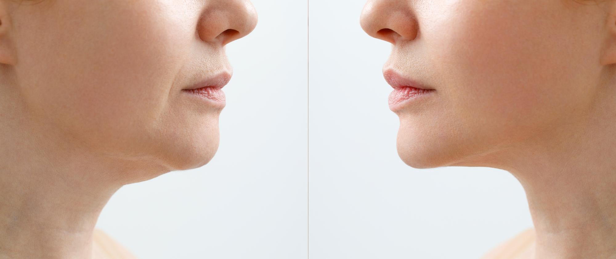 Side-by-side before and after photos of a woman showing a noticeable reduction in her double chin, with firmer and more rejuvenated skin after treatment.