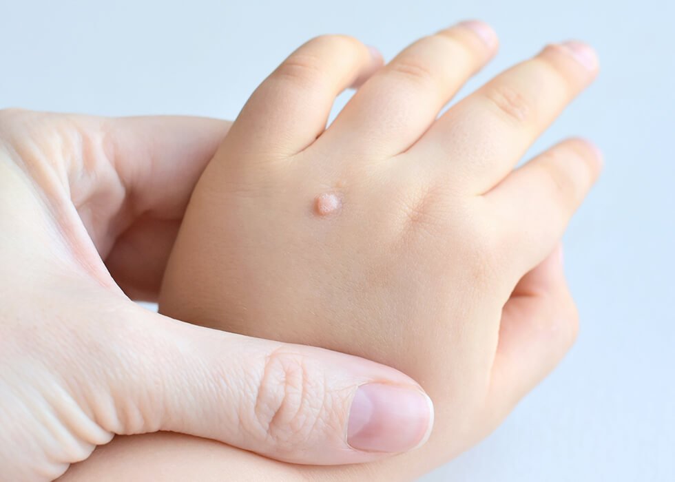 Close-up of a child's hand showing multiple warts on the skin. This image highlights the appearance of common warts and the importance of dermatological treatments for viral skin infections.