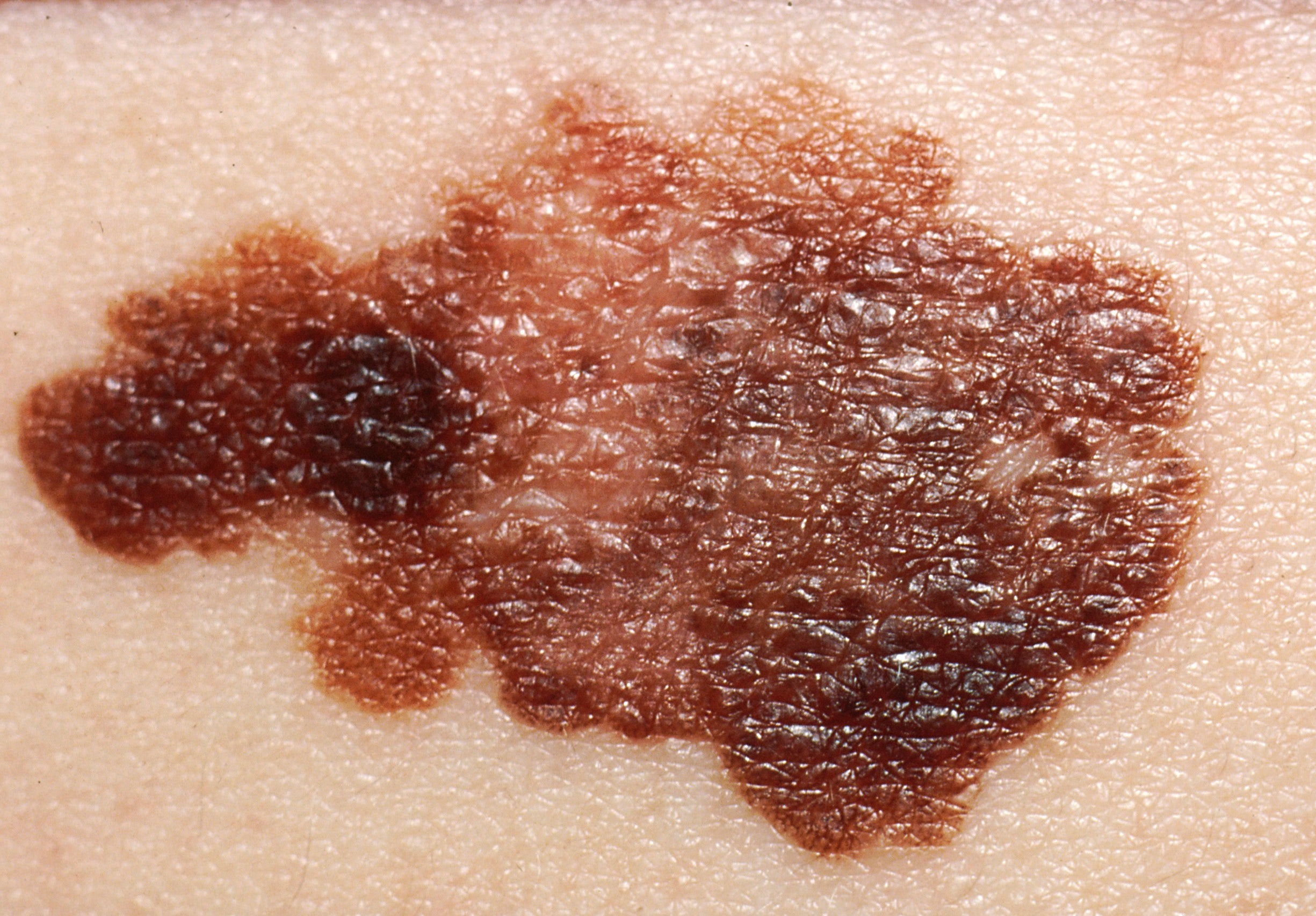 Close-up of a dark brown mole with irregular borders and uneven coloration, indicating possible signs of skin cancer. This image highlights the importance of dermatological evaluation for early detection and treatment of suspicious moles.