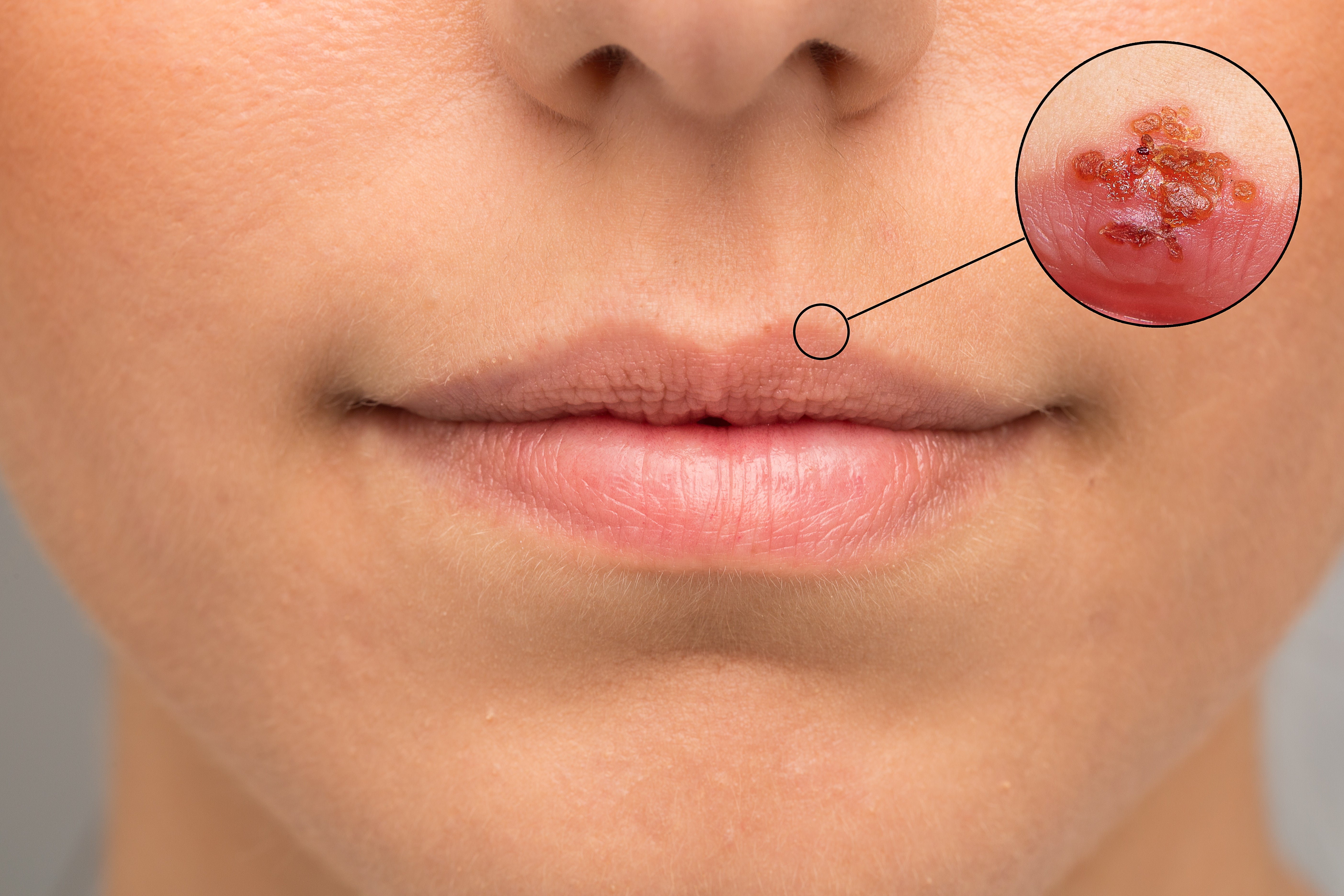 Close-up of a person’s lip showing visible sores and lesions, indicative of a sexually transmitted infection (STI) such as herpes simplex virus (HSV). This image highlights the importance of dermatological care for diagnosis and treatment of oral STDs.