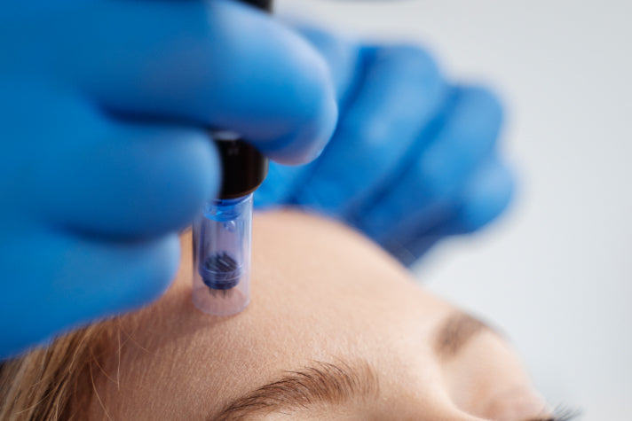 Close-up of a dermatologist’s hand wearing blue surgical gloves, performing a microneedling procedure on a patient's forehead to improve skin texture and stimulate collagen production.