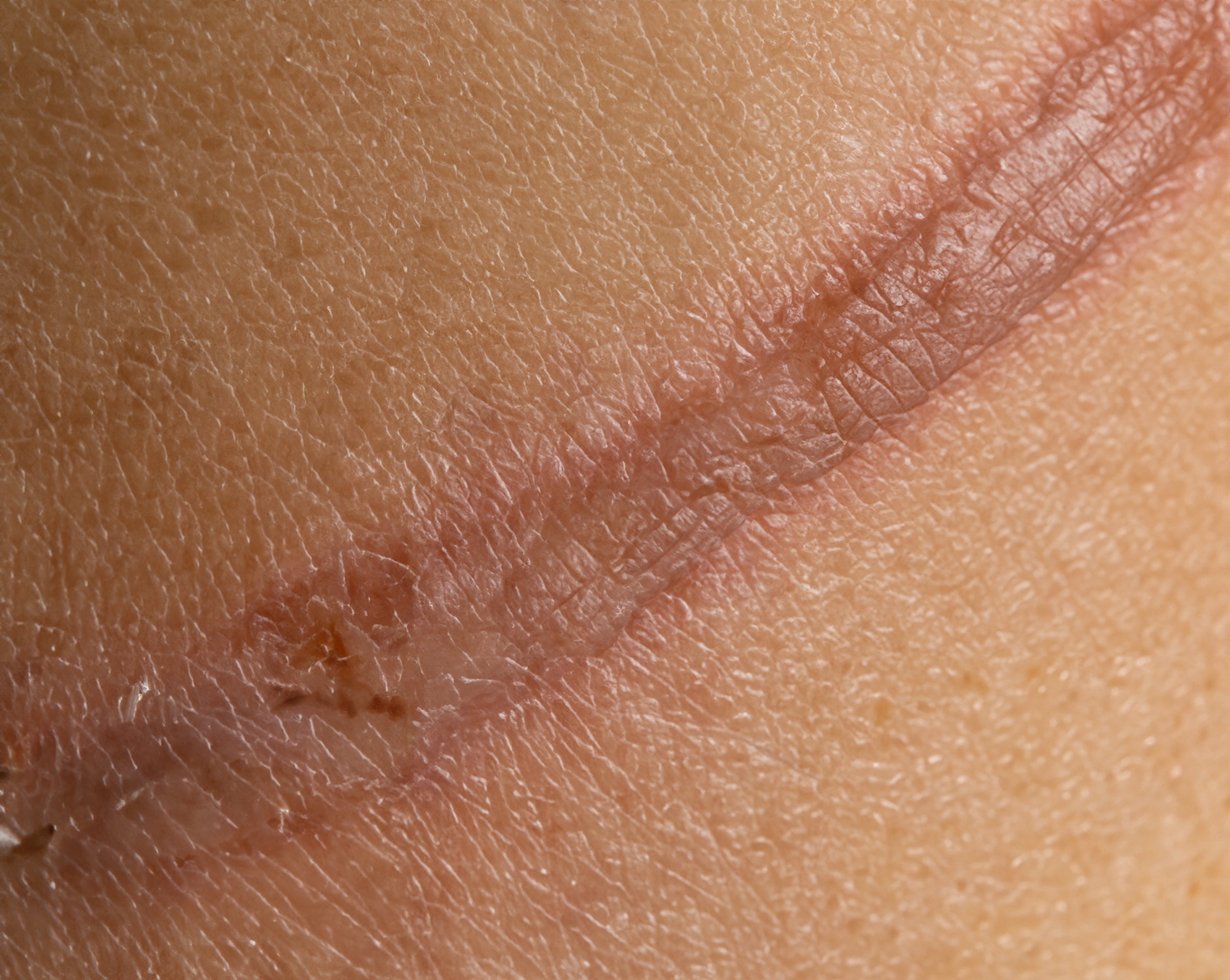 Close-up of a scar on the skin, showing its texture and healing process. This image highlights the appearance of scars and the importance of dermatological treatments for scar reduction and skin regeneration.