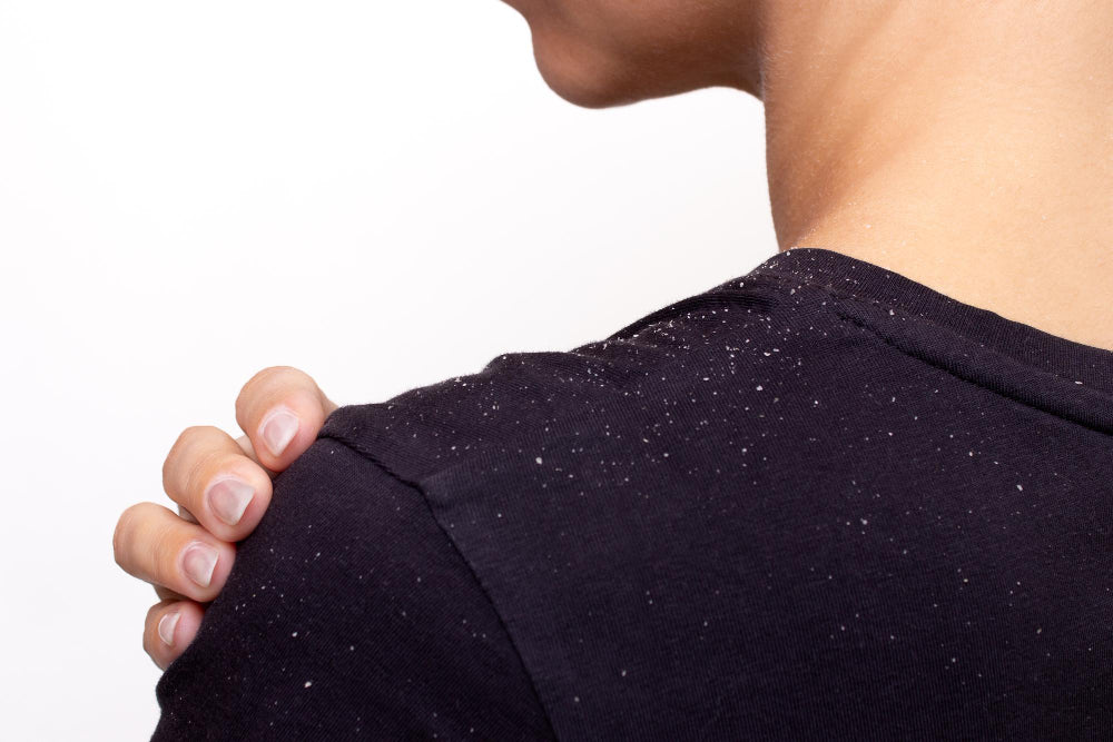 A young man seen from behind, showing dandruff flakes on his shoulders, which stand out against his dark-colored shirt. This image highlights common scalp issues and the need for dermatological treatment for dandruff control.