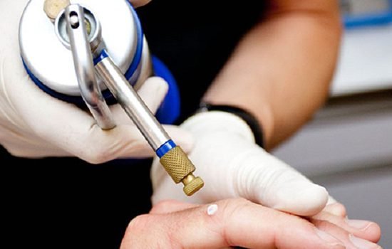 A dermatologist performing a cryosurgery procedure using liquid nitrogen on a patient's hand to treat a skin condition.