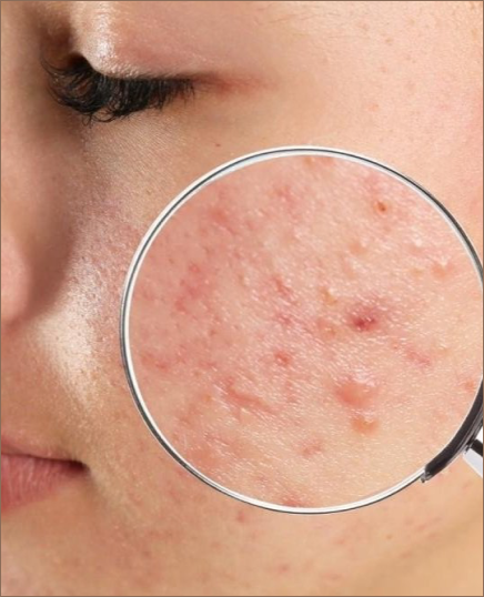 Close-up of a dermatologist holding a magnifying glass over a woman's cheek, highlighting her acne. A professional skin examination helps diagnose and treat acne for clearer, healthier skin.