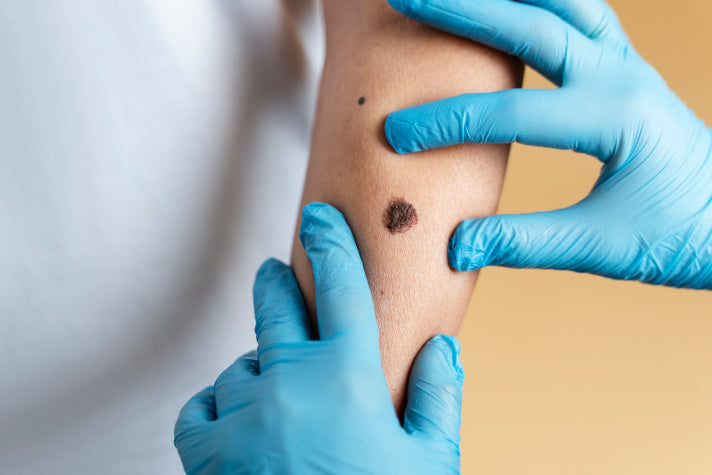 A dermatologist examining a melanoma on a patient’s skin, highlighting the irregular shape and dark pigmentation characteristic of skin cancer. This image emphasizes the importance of professional skin checks for early detection and treatment of melanoma.