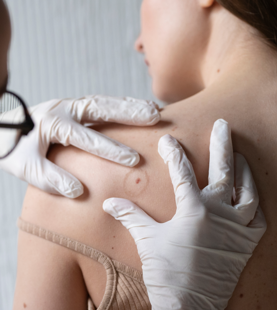 Dermatologist examining a mole on a patient's back in a medical office. Regular skin checkups help detect early signs of skin cancer and other dermatological conditions.