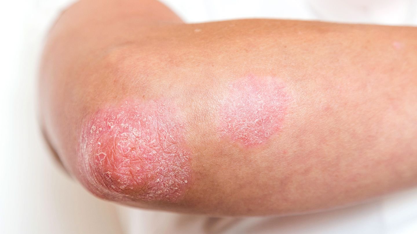 an elbow showing the scaly, red patches characteristic of psoriasis. 