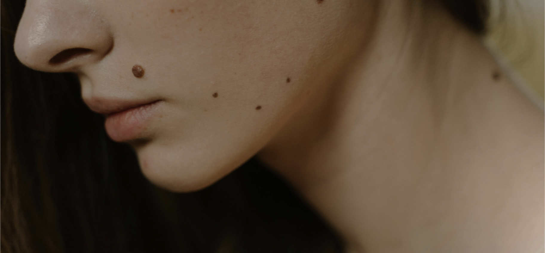 Close-up of a woman's face and neck showing multiple moles. This image highlights the importance of regular skin checks for mole evaluation and early detection of skin conditions.