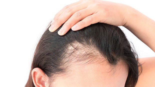 Close-up of a person with black hair showing signs of hair loss, highlighting a receding hairline and thinning areas. This image illustrates common hair thinning concerns and the importance of dermatological treatments for hair restoration.