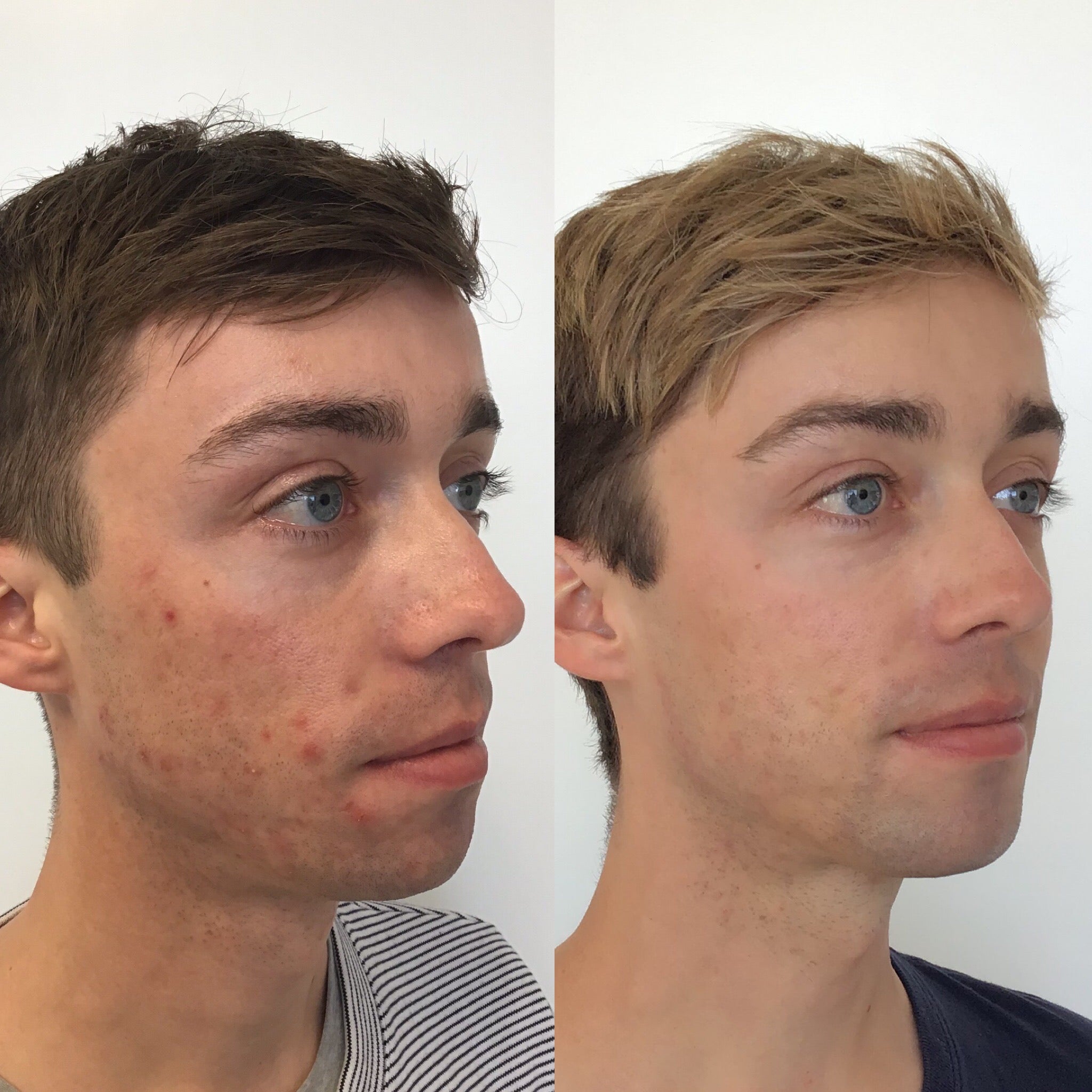 Before and after image of a young teenager with white skin who underwent an acne treatment, showing noticeable improvement in skin clarity and texture.