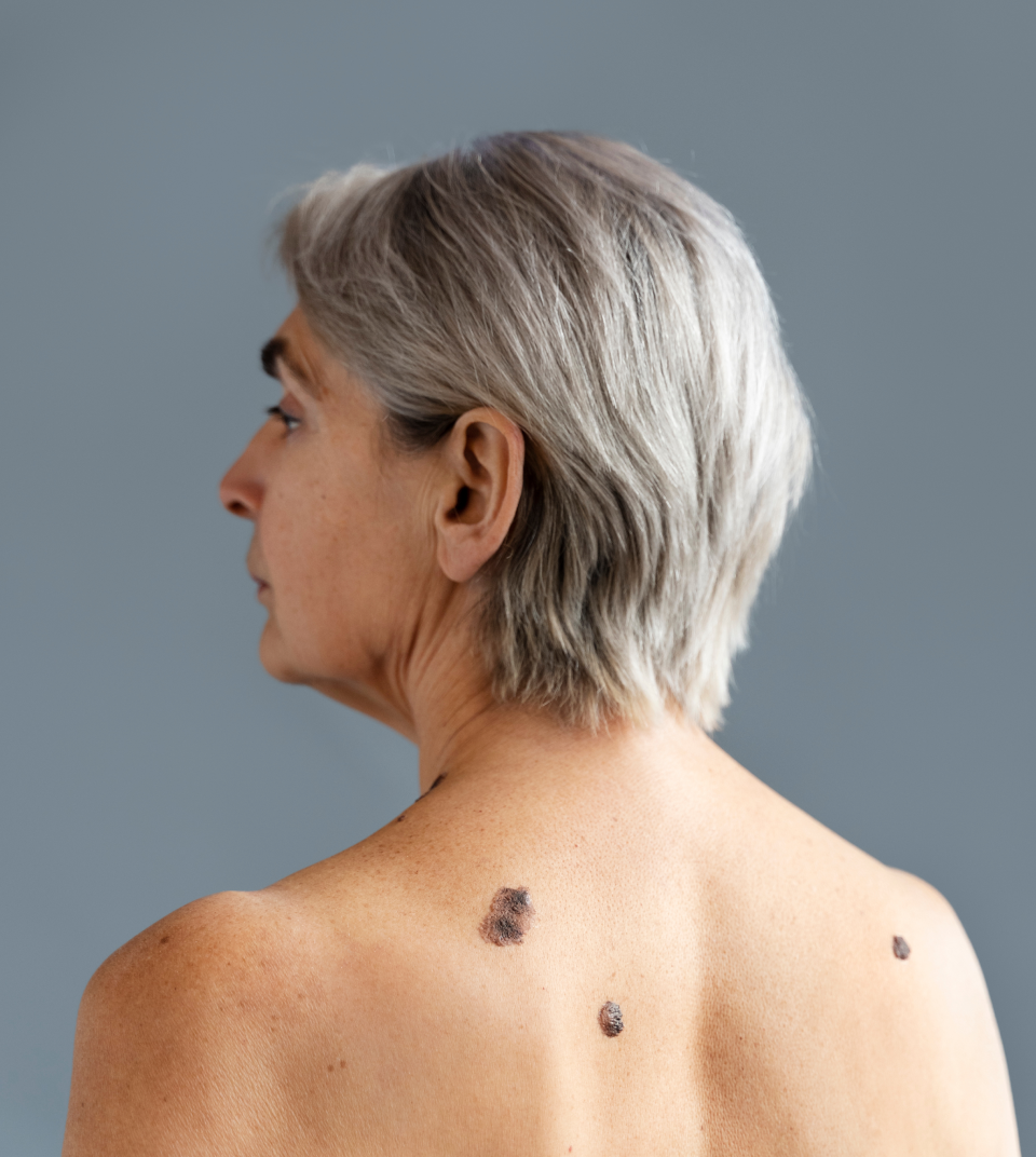 Senior woman with suspicious moles on her back, a potential sign of skin cancer. Dermatology checkups are essential for early detection and treatment of melanoma and other skin conditions.