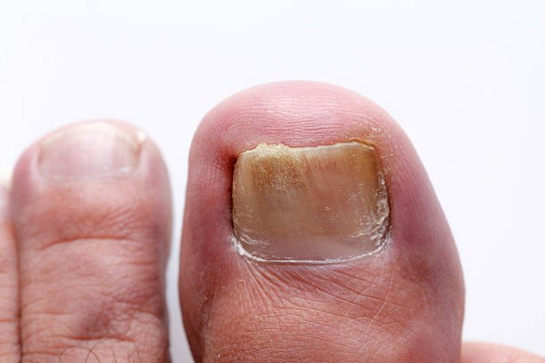 toenail showing signs of onychomycosis, with discoloration and thickening of the nail. 