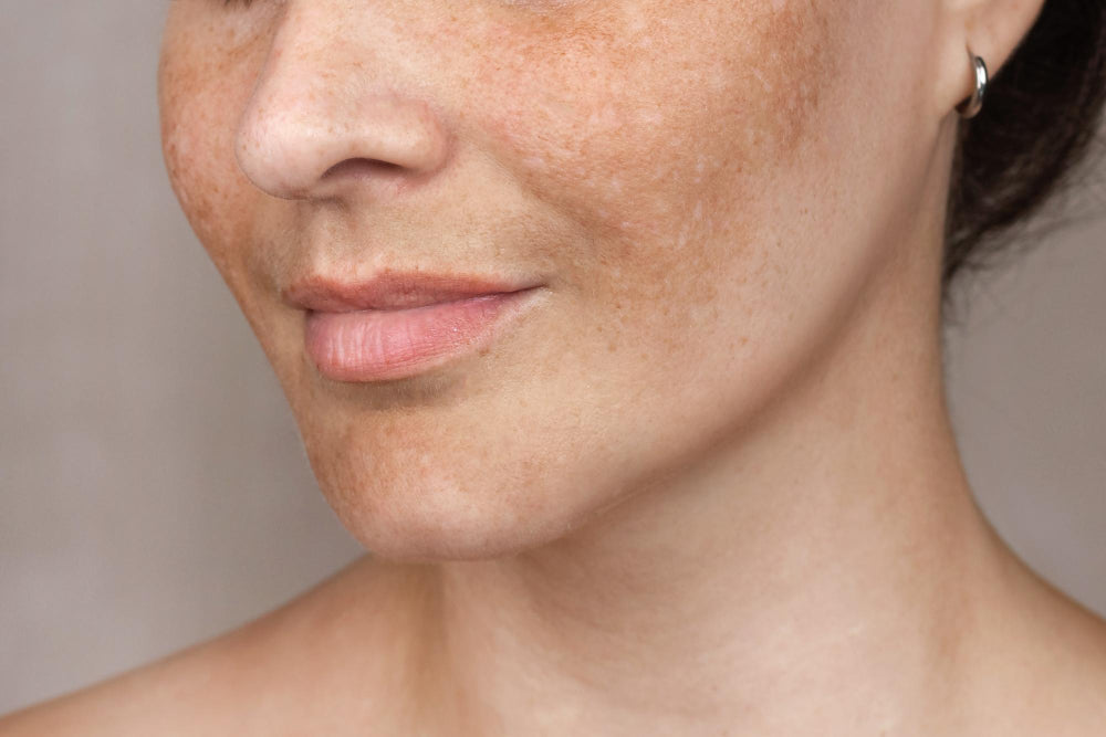 Close-up of the lower half of a woman's face, showing visible melasma spots on various areas of her skin. This image highlights the common pigmentation disorder and the importance of dermatological treatment for managing melasma.