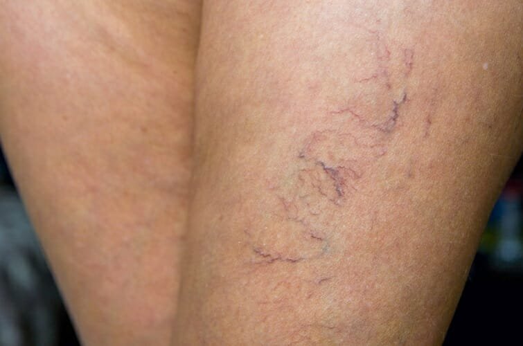 A woman showing visible varicose veins on her legs, characterized by swollen, twisted veins beneath the skin. This image highlights the appearance of varicose veins and the importance of dermatological treatments for circulation and vein health.