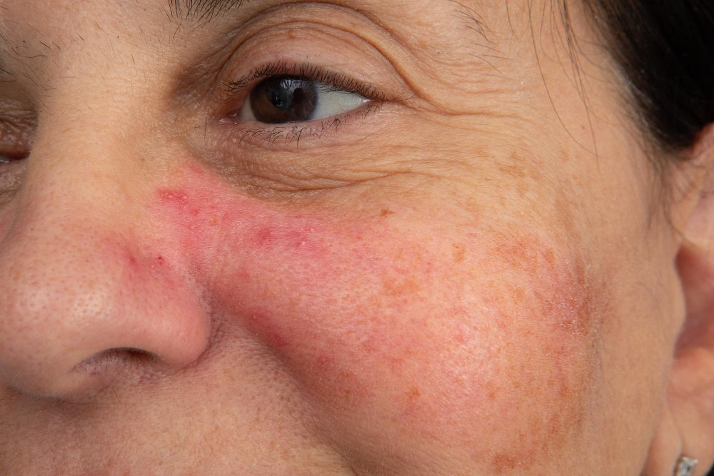 Close-up of a middle-aged woman’s cheek showing visible signs of rosacea, with redness and bumps. This image highlights the common symptoms of rosacea and underscores the importance of dermatological care in managing this skin condition.